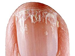 peeling-nails-symptoms-causes-and-treatment-of-peeling-fingernails