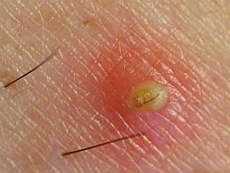 Ingrown-hair-with-pus