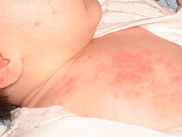 Baby acne on chest