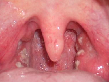 White Spots In The Back Of The Throat 6