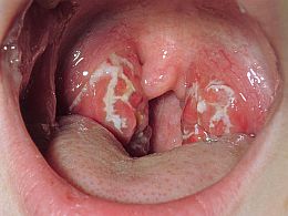 white-spots-on-throat-strep-throat