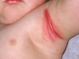 Itchy armpit rash