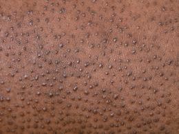 Itchy Armpits caused by Keratosis pilaris