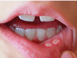 How to get rid of canker sores