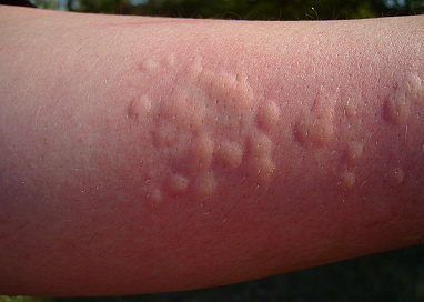 strawberry-allergy-symptoms