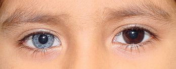 complete-heterochromia