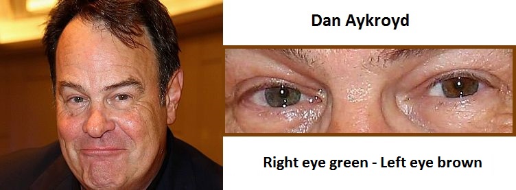 dan-aykroyd-complete-heterochromia-3