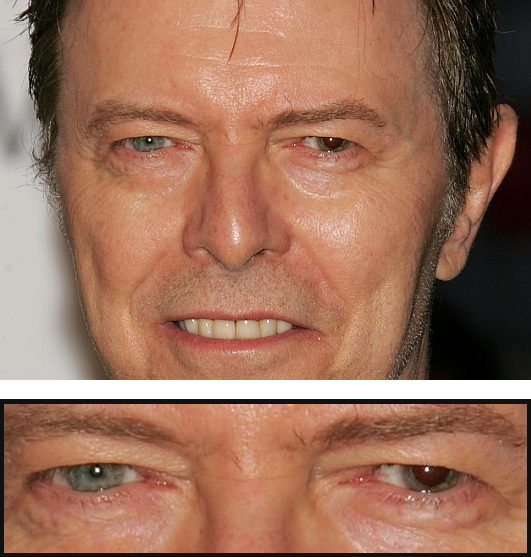 david-bowie-heterochromia