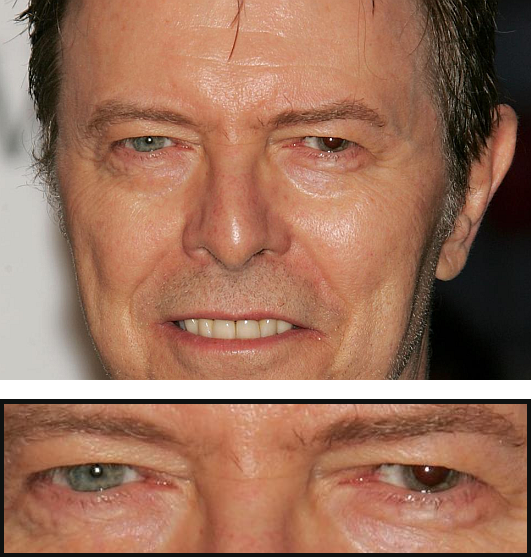 david bowie heterochromia