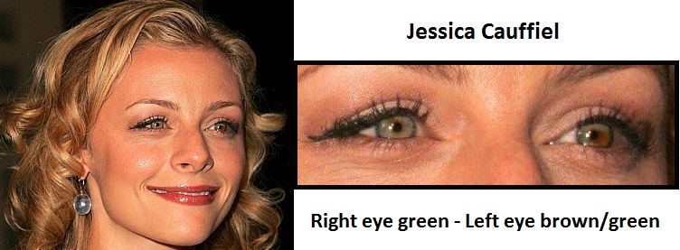 jessica-cauffiel-sectoral-heterochromia-3