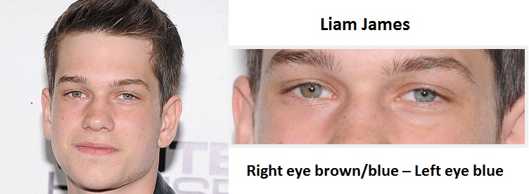 liam-james-sectoral-heterochromia-3