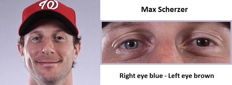 heterochromia max scherzer