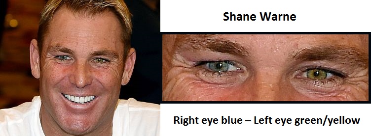 shane-warne-complete-heterochromia-3