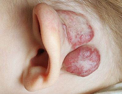 baby-with-hemangioma