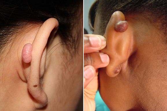 keloid-cartilage-bump-behind-ear