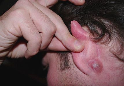 pimple-behind-ear