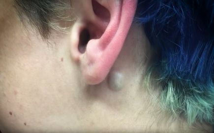 A small cyst close to the earlobe.